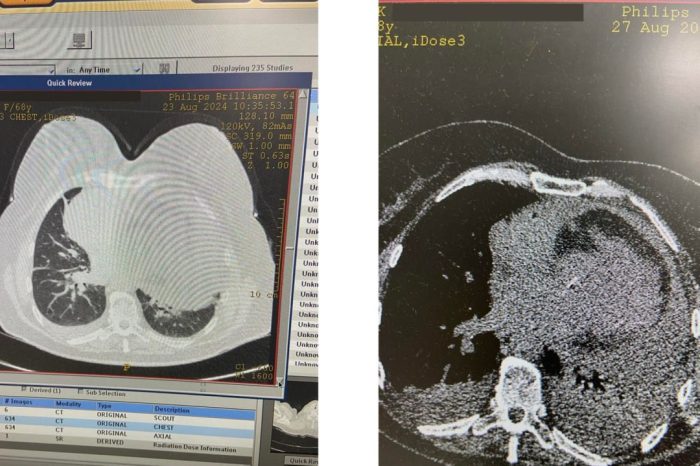 Au eliminat aproximativ un litru de lichid din inimă: o pensionară a fost salvată la Centrul Cardiologic din Cernăuți